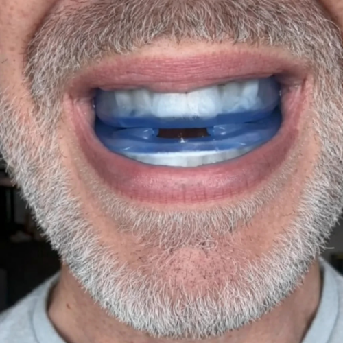 Honex Anti-Snoring Mouthpiece (Buy 1 Get 1 Free)