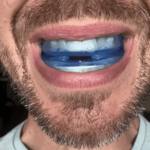 Honex Anti-snoring Mouthpiece (official Retailer) 2025